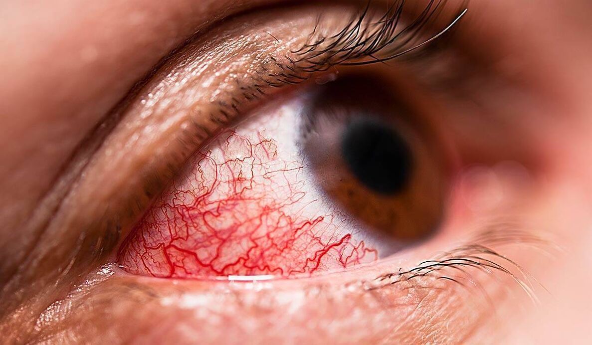 Diabetická retinopatia je jednou z oneskorených komplikácií cukrovky